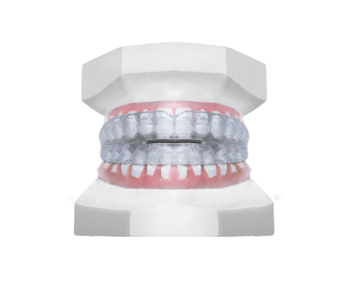 Pressform Appliance Archives - Universal Orthodontic Lab