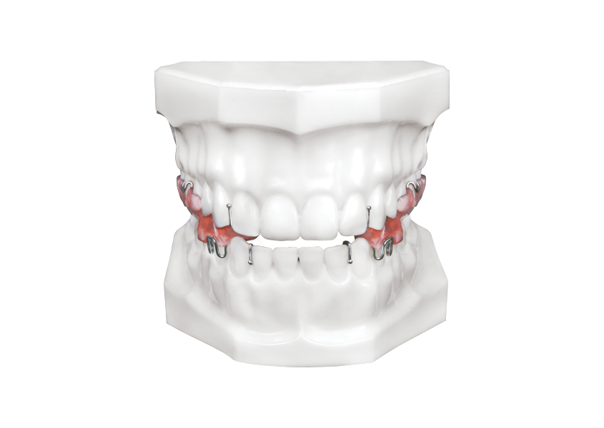 Twin Block - Universal Orthodontic Lab