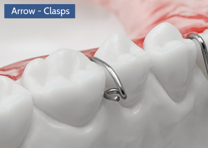 Clasps | Universal Orthodontic Lab